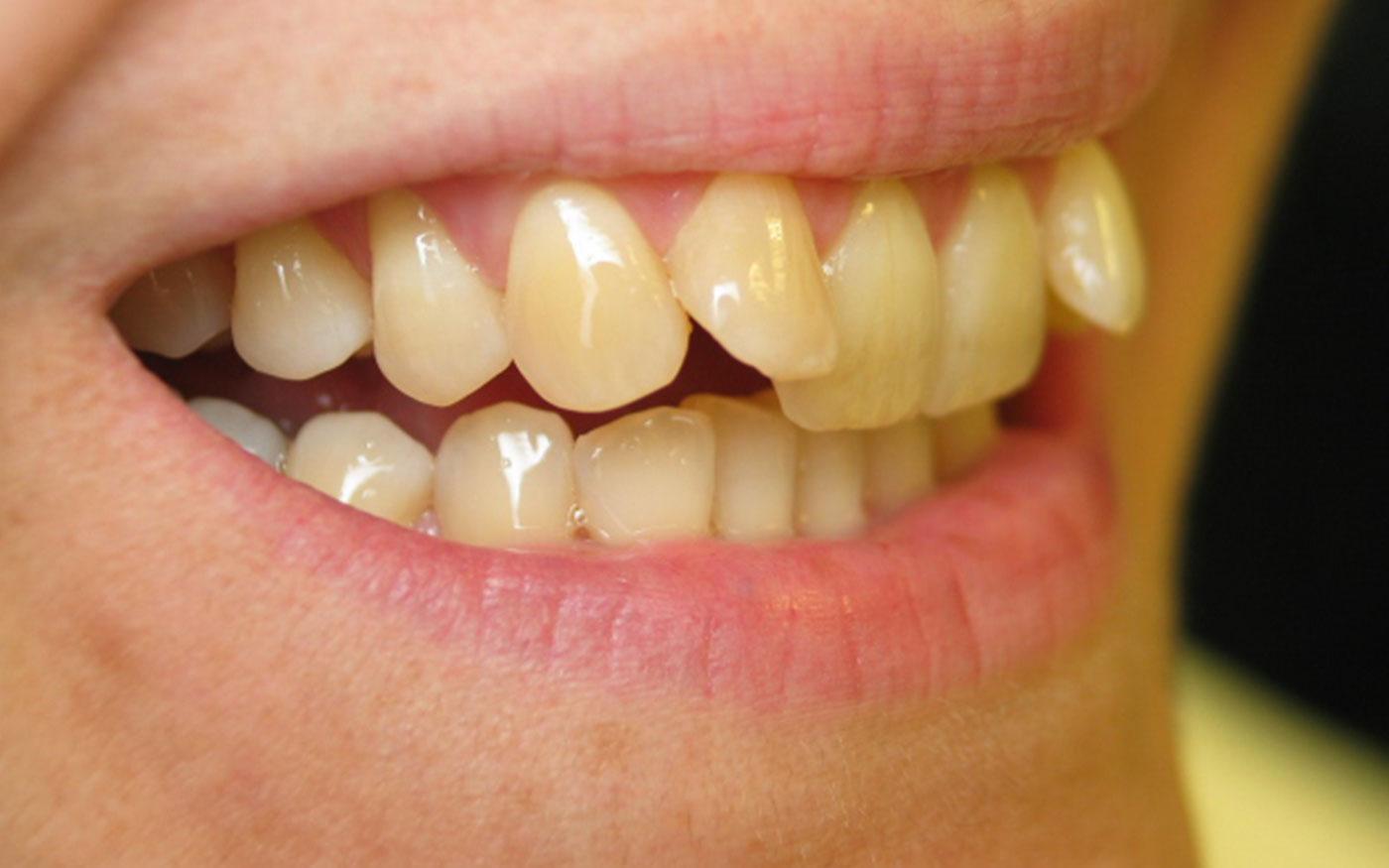 Orthodontics - Inman Aligner - Case 7
