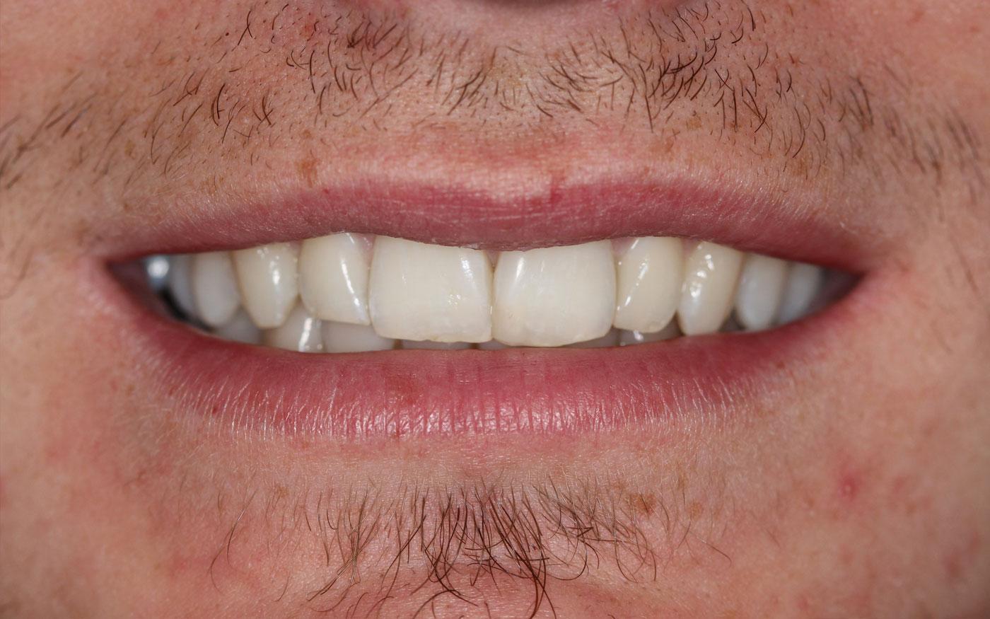 Orthodontics - Clear Aligner - Case 1