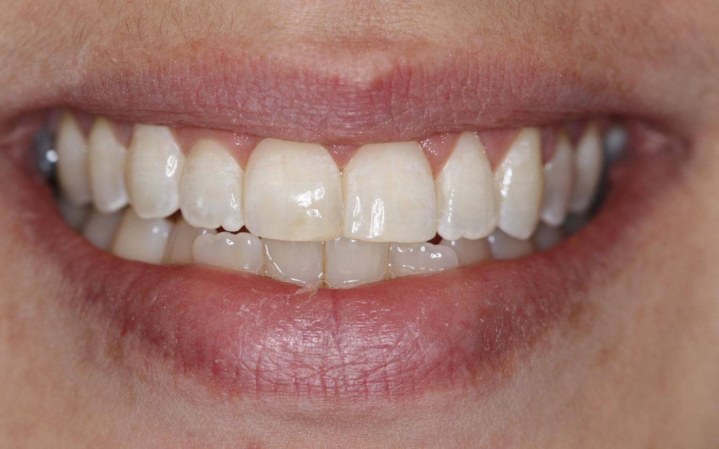 orthodontics clear aligner case 2 after