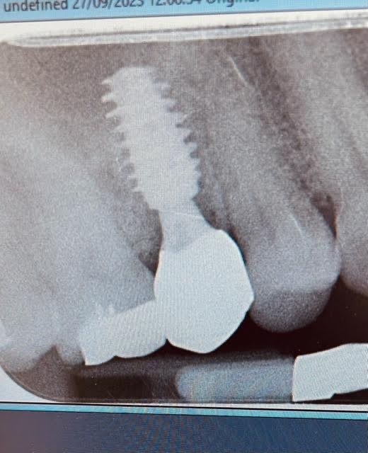 This single missing side tooth was replaced with an implant . The X-ray shows the implant placed in the bone replacing the lost tooth Lovely colour match and healthy tissue