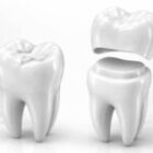 When Does a Tooth Need a Crown Instead of a Filling?